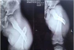 莫让“小意外”变“大遗憾”，冬季老年人防摔知多少