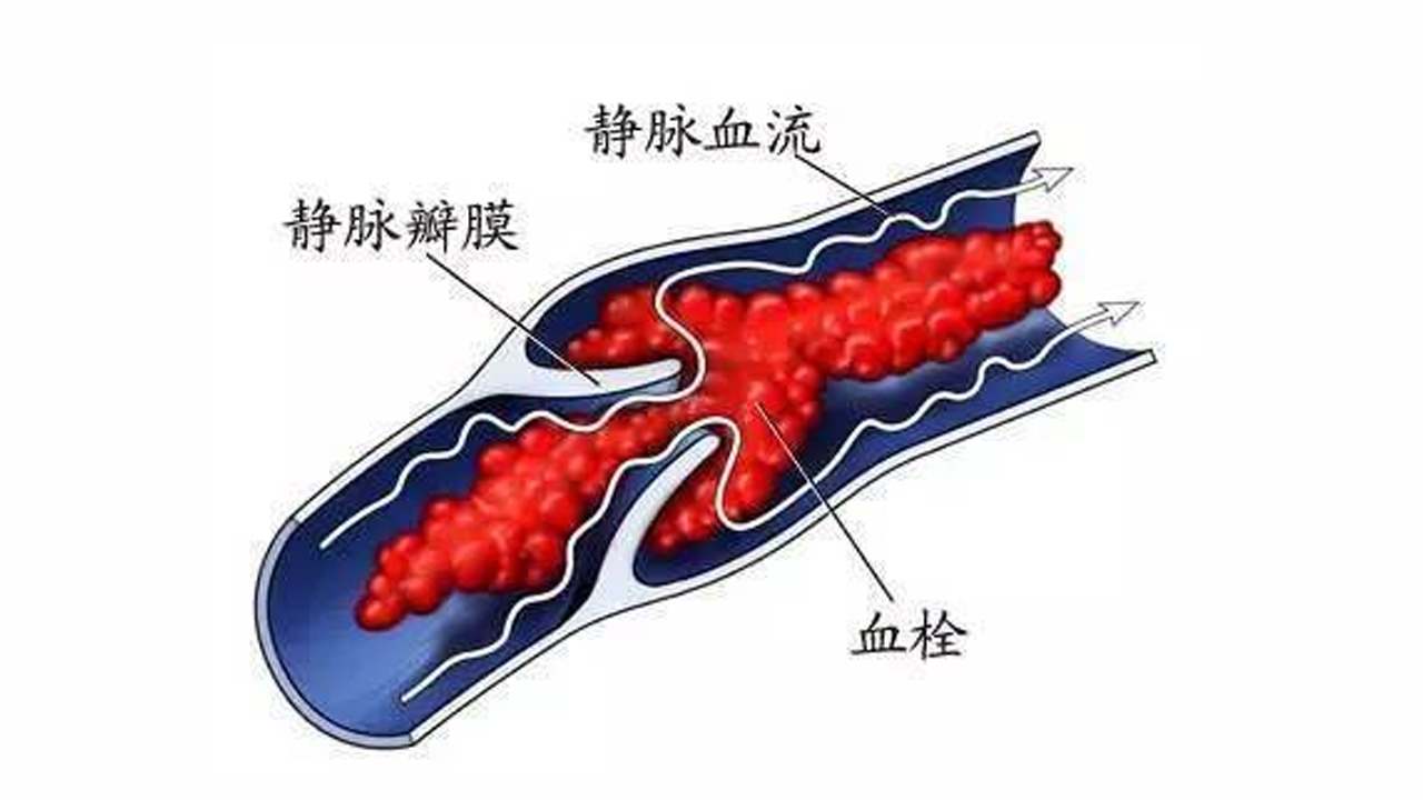 深静脉血栓：静脉血栓 是“溶”还是“取”