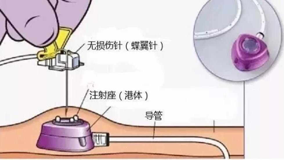 多学科协作破高龄治疗难题，输液港技术启精准医疗新篇--成人快手
以创新实践守护患者健康